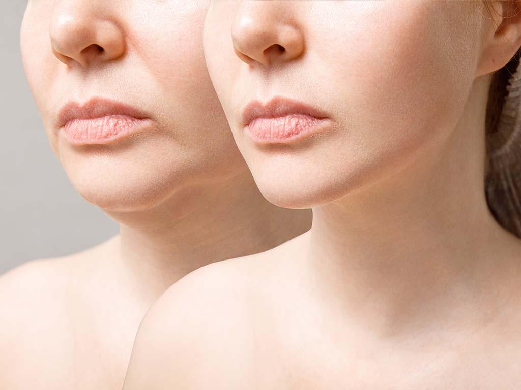 Lip Lifts are Trending for Good Reasons