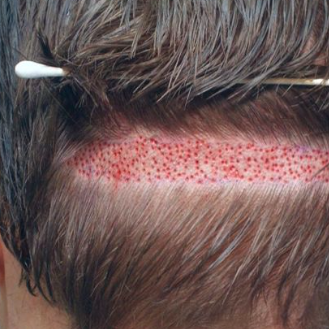 Hair Transplant Pakistan 