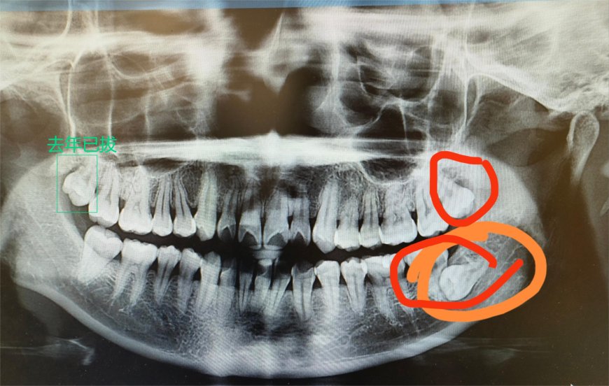 记全麻住院拔智齿