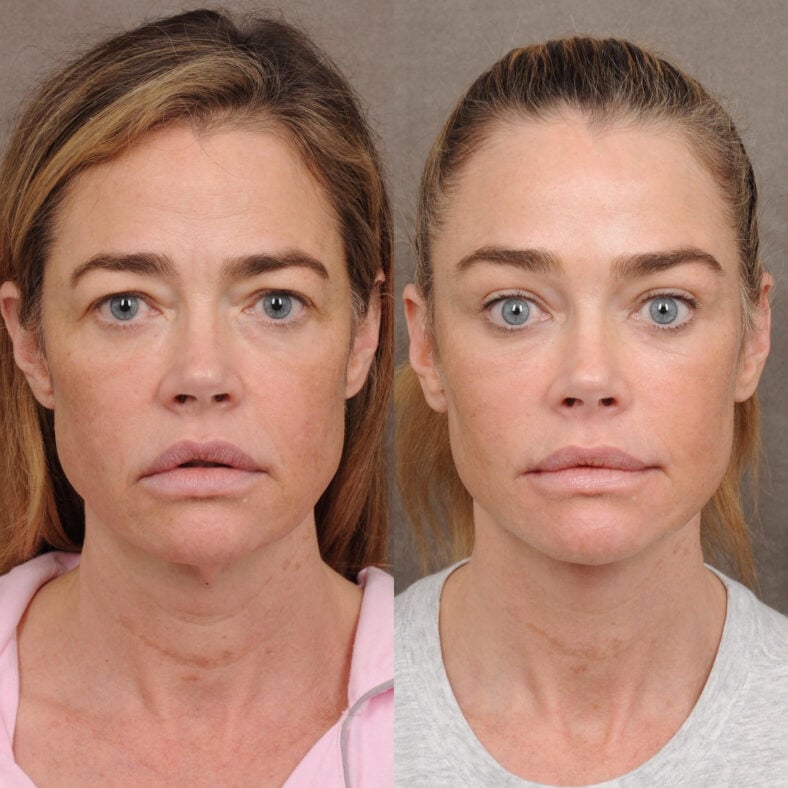 Denise Richards shows off the stunning results of her facelift