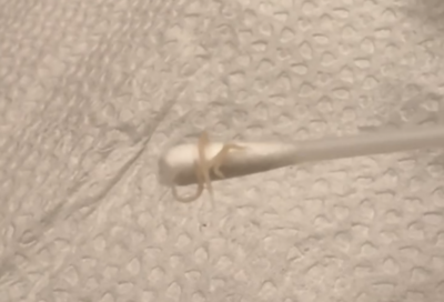 正妹媽驚見女兒屁股「爬出蟯蟲」　半夜掏出3、4隻嚇爛