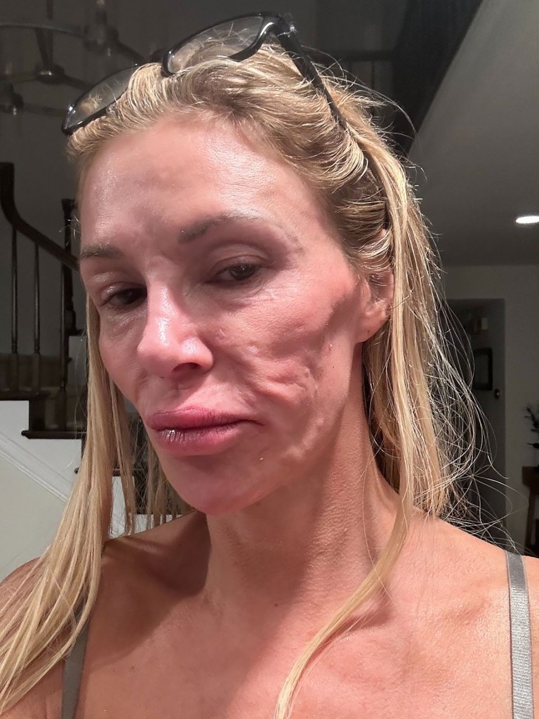Everything Brandi Glanville Has Said About Her Facial Disfigurement X