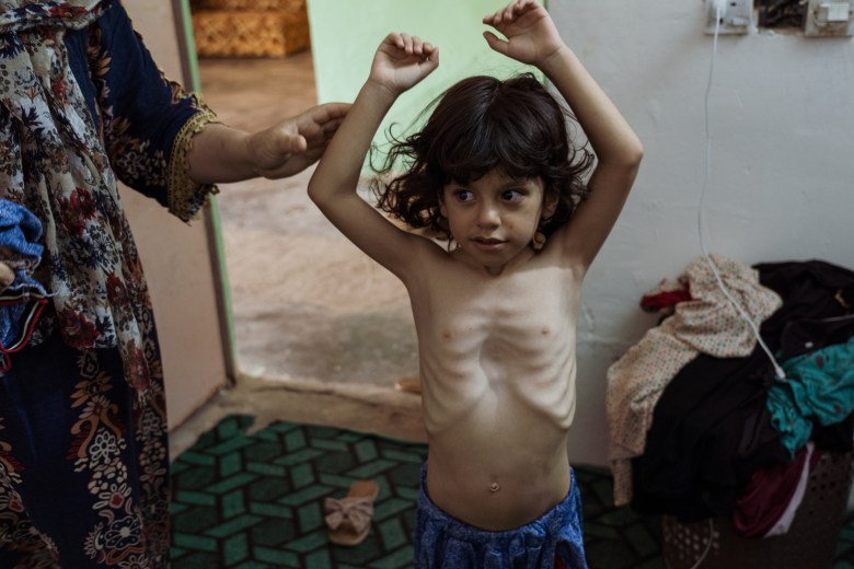 Rana Khaider lifts her son’s shirt to show the congenital defects he was born with. Photo by Jaclynn Ashly.