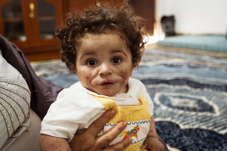 Scars mark Saman’s face after repeated bouts of a severe skin disease. Like many children in Fallujah, his condition reflects what families and doctors describe as the city’s toxic legacy from the 2004 assaults. Photo by Jaclynn Ashly.