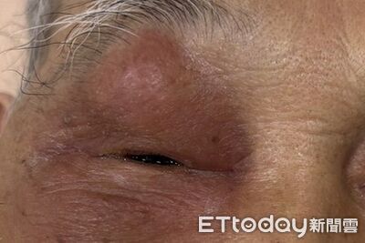 老翁眼皮腫到睜不開　醫揪出「鼻竇炎」害眼周塞滿膿瘍