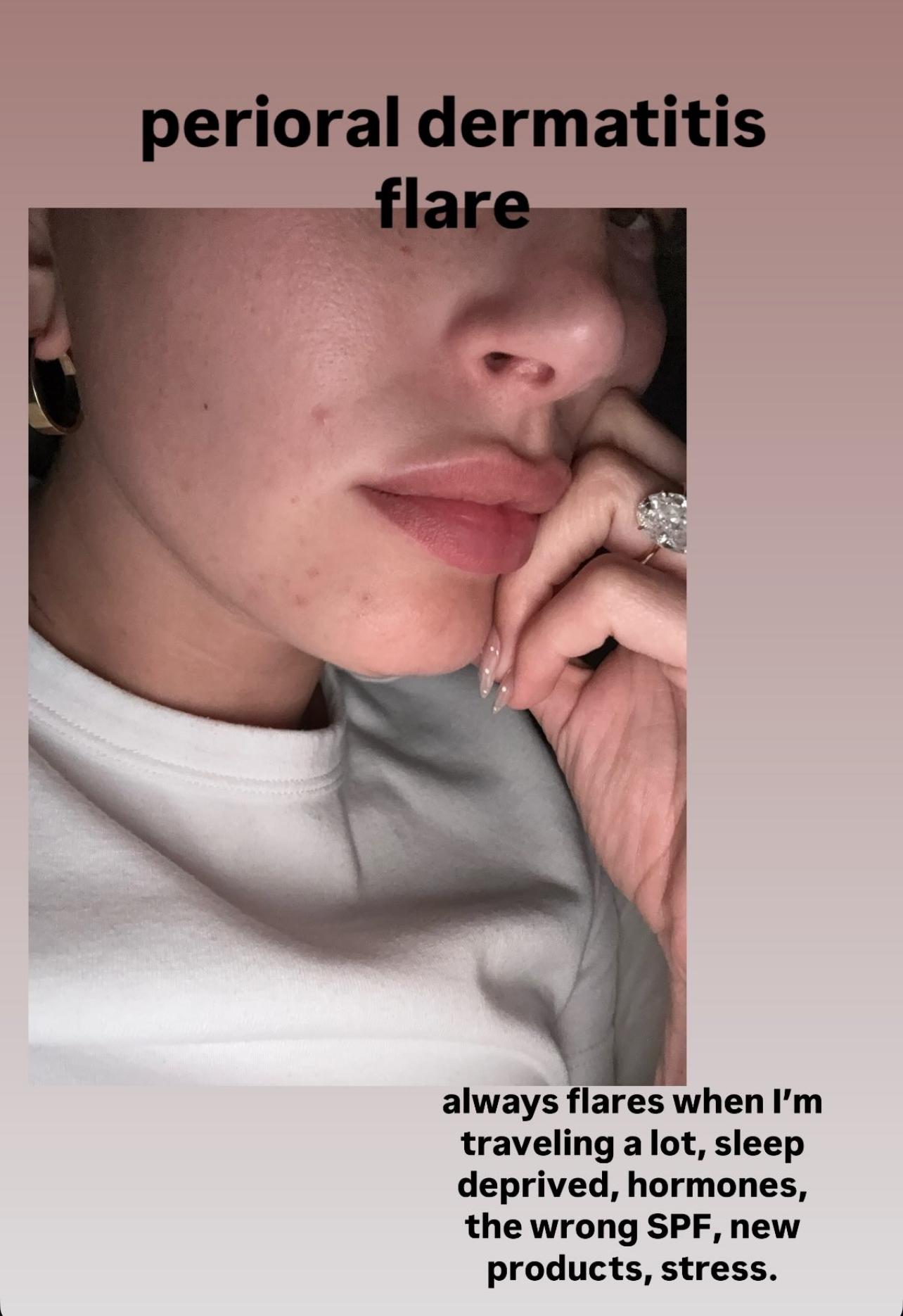 Hailey Bieber breaks silence on stress