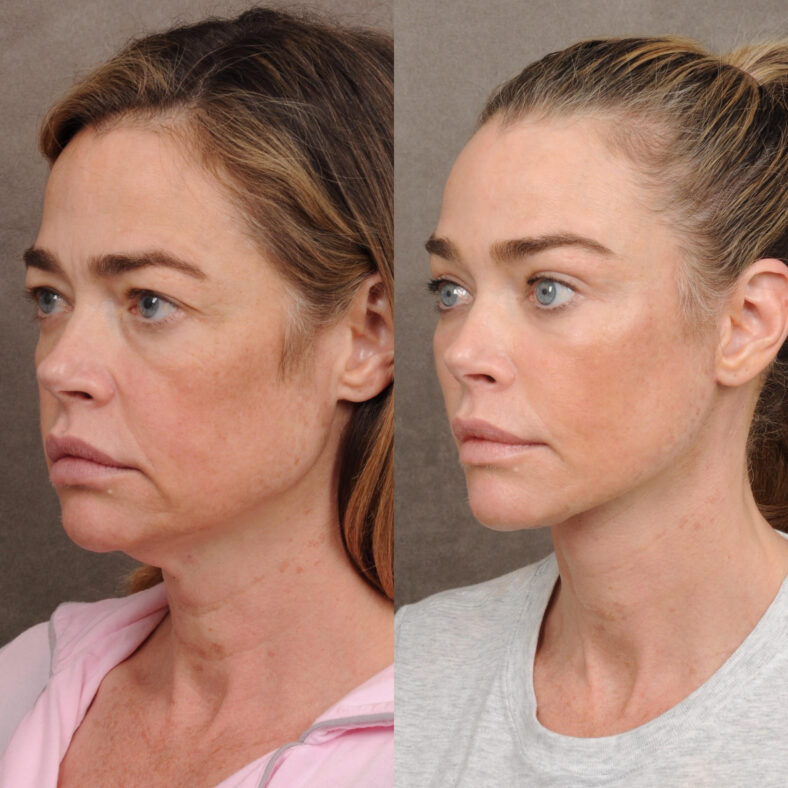 Denise Richards shows off the stunning results of her facelift