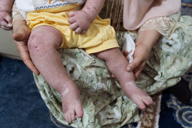 Skin irritations and lesions mark the legs of Iman’s 11-month-old child—one of many unexplained health conditions that parents and doctors in Fallujah link to wartime contamination left behind after 2004. Photo by Jaclynn Ashly.